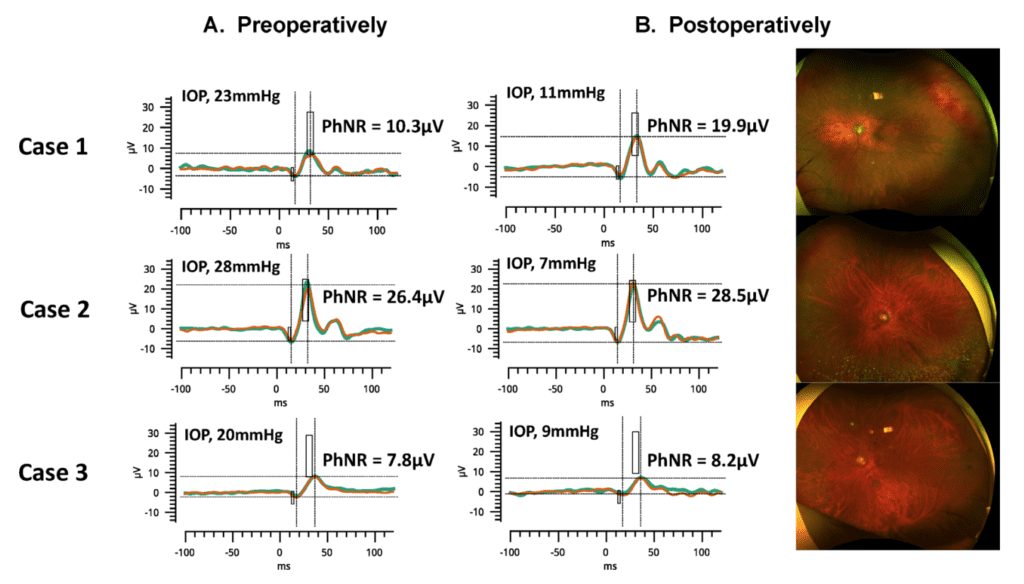 PHnR glaucoma results