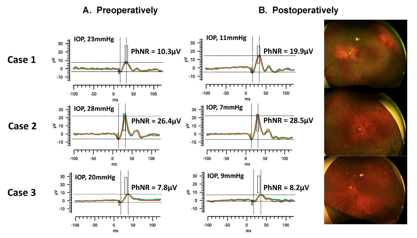 Early Changes In Photopic Negative Response In Eyes With Glaucoma - LKC ...