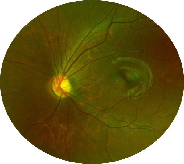 ERG Supports Diagnostic Accuracy in a Pediatric Patient - LKC Technologies