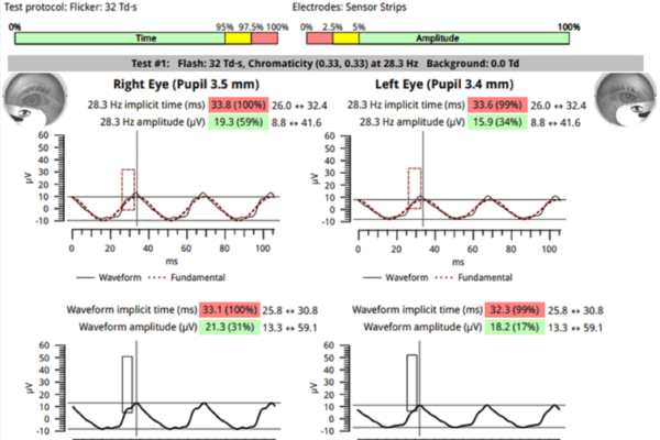 ERG report - Flicker 32Td protocol