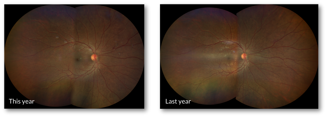 Fundus (OD)